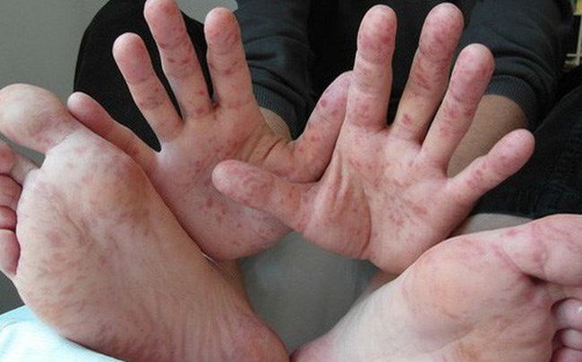 6 ca tử vong vì bệnh tay chân miệng: Chủng virus EV71 nguy hiểm thế nào?