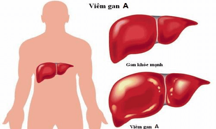 Bệnh viêm gan A là gì? Lây qua những đường nào?