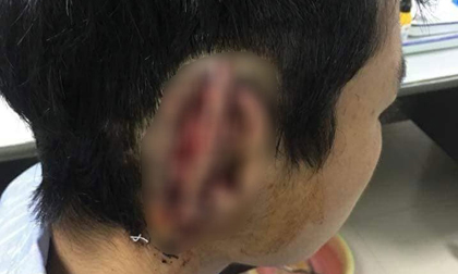 Nam sinh nghi 'ngáo đá' cắn đứt rồi nuốt tai phải của bạn vào bụng
