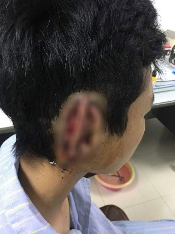 Nam sinh nghi ngáo đá cắn đứt rồi nuốt tai phải của bạn vào bụng Nam sinh nghi ngáo đá cắn đứt rồi nuốt tai phải của bạn vào bụng