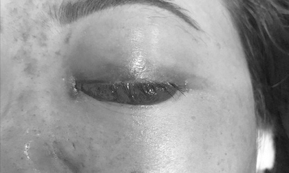 Chủ tiệm spa bị phạt tiền vì tiêm filler gây mù mắt