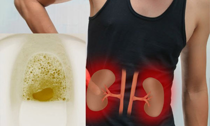 Chàng trai 32 tuổi đột nhiên bị suy thận cấp chỉ vì làm 2 việc trong thời gian dài