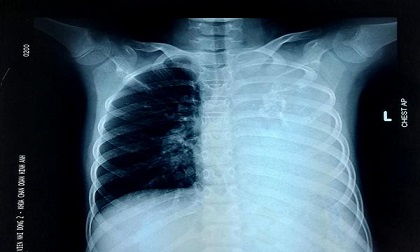 Bé gái ho dai dẳng kéo dài vì mắc bệnh cực hiếm, cả thế giới chưa đến 20 trường hợp