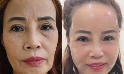 Cô dâu 62 tuổi tiến hành phẫu thuật thẩm mỹ, nhan sắc mới trẻ trung như ở tuổi 40