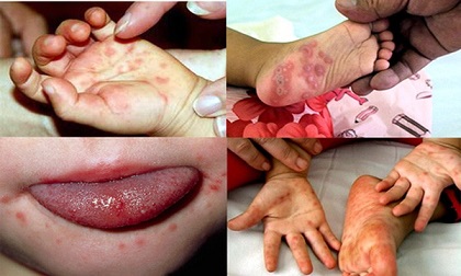 Dịch tay chân miệng: Lại thêm trẻ tử vong - cha mẹ cần làm điều này ngay khi con bệnh để cứu bé