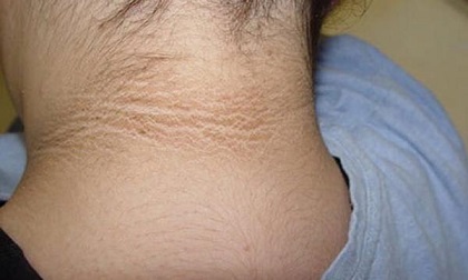 Thấy cổ con có vết đen tưởng cháy nắng nhưng hóa ra là dấu hiệu bệnh không thể bỏ qua