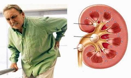 Thấy có 8 dấu hiệu bất thường này bạn phải đi khám ngay kẻo chạy thận suốt cả đời