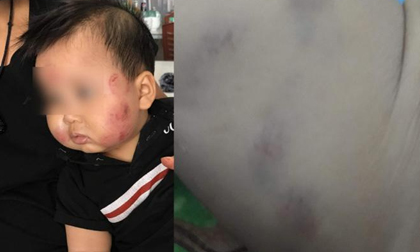 Thông tin bất ngờ vụ bé trai 10 tháng tím đùi, mặt nhiều vết thương khi đi học mầm non