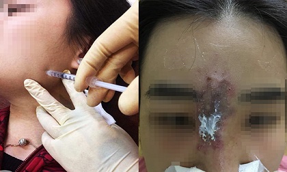 Nữ sinh 19 tuổi biến dạng mặt, suýt mù mắt vì tiêm filler nâng mũi