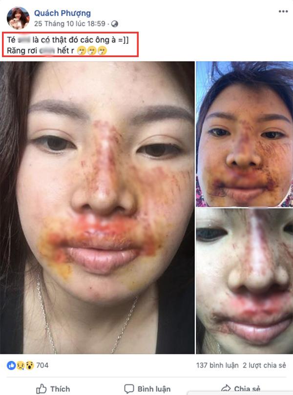 bi che xuong sac hau dao keo, phuong 
