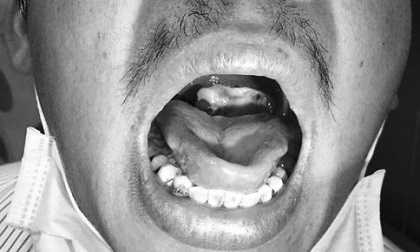 Ngỡ cảm sốt thông thường, chàng trai 30 tuổi suýt chết vì bệnh bạch hầu