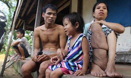 Cảm động chuyện tình “rổ rá” giữa cô nàng “chân voi” và anh chàng mù