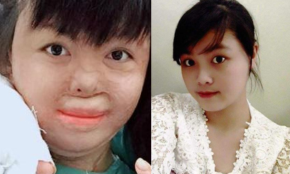 Hé lộ cuộc sống mới của 9x xinh đẹp từng bị chồng thiêu cháy, con khóc ré không nhận mẹ