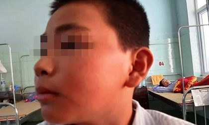 Cậu bé Quảng Bình sợ hãi kể lại giây phút bị cô giáo phạt 231 cái tát đến nhập viện