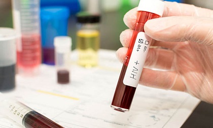 9 triệu chứng HIV thường gặp ở phụ nữ