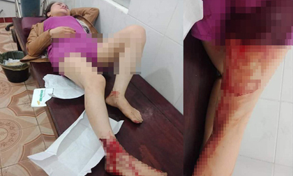 Chị dâu tố em rể hành hung phải nhập viện với nhiều thương tích