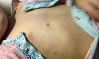 Hàng trăm bác sĩ cảnh báo căn bệnh lấy mạng trẻ nhỏ trong vài tiếng cha mẹ hãy biết để cứu con