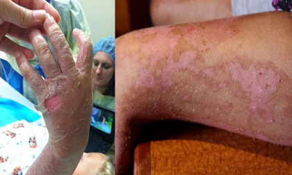 Sốc: 5 bé gái bị bỏng nặng sau khi trêu đùa thứ mọi gia đình đều có trong bếp