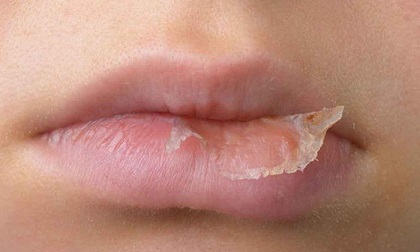 Thấy môi chuyển sang màu này mặc dù không tô son, hãy chủ động đi khám ngay đề phòng căn bệnh nguy hiểm