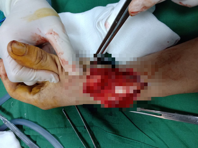 Vụ chặt tay tài xế ô tô: Đã bắt được hung thủ là người đi xe máy - Ảnh 4.