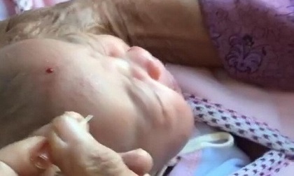 Choáng với phương pháp lấy kim chích nặn máu độc để trẻ 'hay ăn chóng lớn'