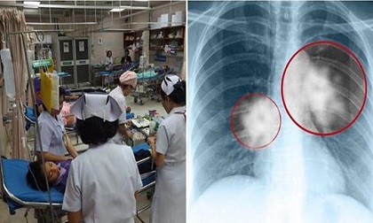 Đi học mầm non e bé bỗng mắc bệnh lao, BS chỉ đích danh con đường lây nhiễm quen thuộc
