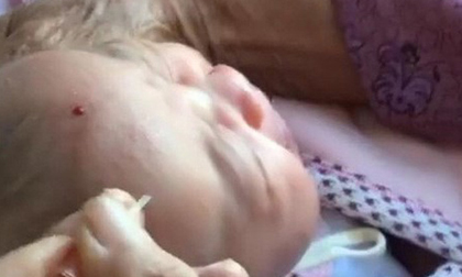 Choáng với phương pháp lấy kim chích nặn máu độc để trẻ 'hay ăn chóng lớn'
