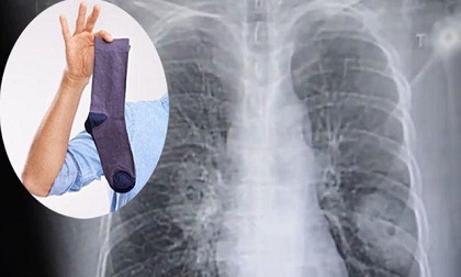 Người đàn ông mắc bệnh nấm phổi chỉ vì thói quen kỳ dị mỗi khi đi làm về