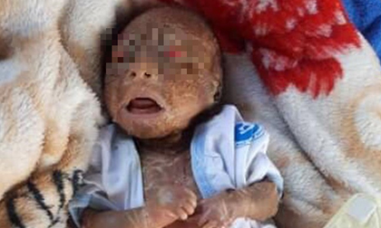 Xót xa bé trai 1 tháng tuổi toàn thân sần sùi, bong tróc như da trăn bị bố mẹ bỏ rơi ngoài đường