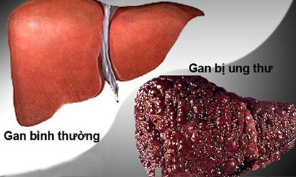 Chuyên gia ung bướu vạch mặt nguyên nhân khiến nhiều người mắc bệnh ung thư số 1 Việt Nam