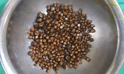 Kinh hoàng bệnh nhân mang gần 400 viên sỏi trong túi mật