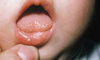 Hà Nội: Cháu bé 13 tuổi tử vong vì tay chân miệng với dấu hiệu bác sĩ cũng không ngờ