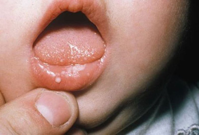 Hà Nội: Cháu bé 13 tuổi tử vong vì tay chân miệng với dấu hiệu bác sĩ cũng không ngờ - Ảnh 1.