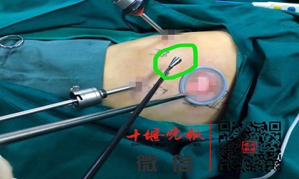 Bé gái 8 tuổi suýt mất mạng vì một thói quen mỗi khi ngồi vào bàn học