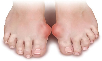 Thực phẩm ngày Tết 'đại kỵ' với người mắc bệnh gout