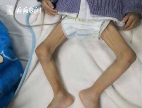 be so sinh chao doi 4,4kg nhung sau mot nam khong ai nhan ra, nguyen nhan qua dang so - 1
