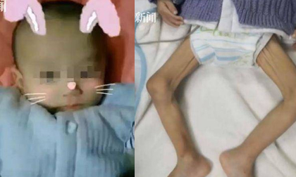 Bé sơ sinh chào đời 4,4kg nhưng sau một năm không ai nhận ra, nguyên nhân quá đáng sợ