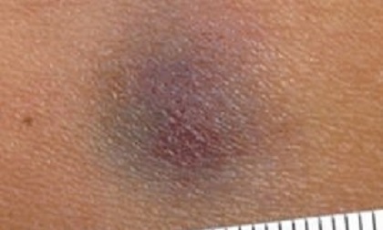 Vết bầm 1 cm kéo dài suốt 6 năm hóa ra là 1 căn bệnh ung thư hiếm gặp