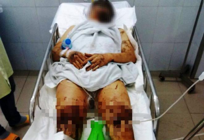 xot xa tam su cua nguoi cha khi thay con trai viet kieu bi tat axit, cat gan chan - 1