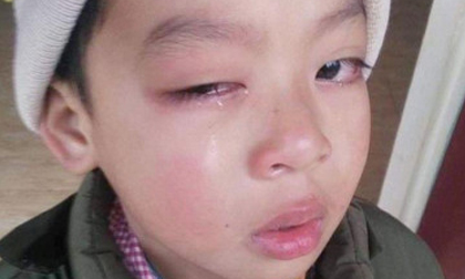 Lạng Sơn: Bé trai có nguy cơ mù vì bị cô giáo chủ nhiệm dùng thước đánh vào mắt