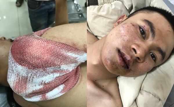 Nạn nhân bị trọng thương nặng, hiện đang điều trị tại bệnh viện. Ảnh: CAND