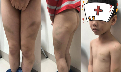 Nghi vấn bé 7 tuổi ở Hà Nội bị mẹ kế bạo hành: Cháu bé được đưa đi giám định