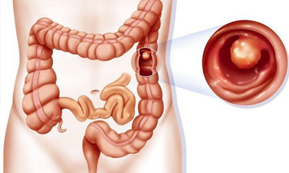 Loại đồ uống ưa thích gây ra 230 bệnh, 8 loại ung thư ở người Việt