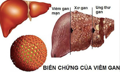 Viêm gan B lây lan nhanh hơn HIV gấp 100 lần, dùng chung bát đũa có lây?