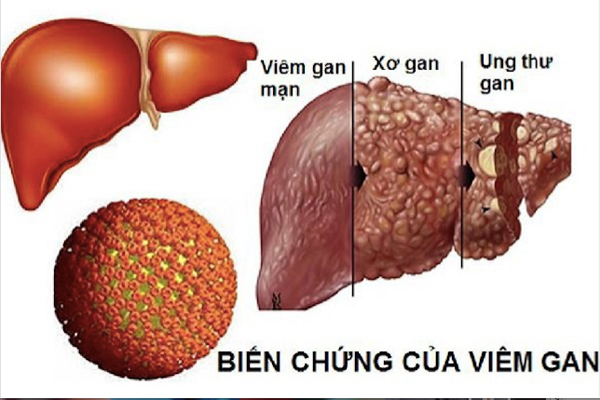 viem-gan-b-lay-lan-nhanh-hon-hiv-gap-100-lan-15-xahoi.com.vn-w600-h400