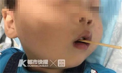 Cậu bé 3 tuổi suýt mất mạng khi ăn xúc xích, cha mẹ chăm sóc trẻ hết sức lưu ý