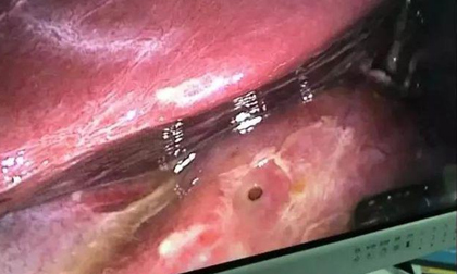 Cậu bé 15 tuổi bị thủng đường tiêu hóa, thủ phạm là thực phẩm hàng triệu người đang sử dụng