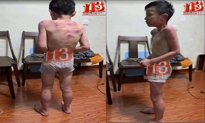 Công an Thanh Hóa xác minh thông tin cháu bé bị cha dượng đánh vằn lưng