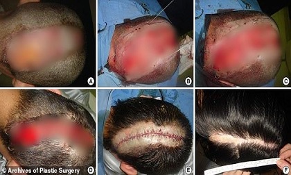 Cô gái bỏng da đầu nghiêm trọng vì kiểu làm đẹp được cả triệu chị em yêu thích
