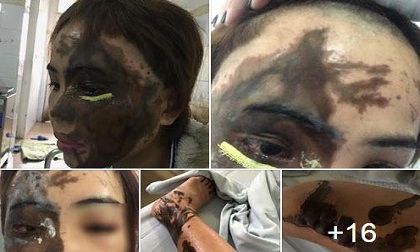 Nỗi xót xa, đau đớn của cô gái Đà Nẵng bị bạn trai tạt a xít trước ngày cưới